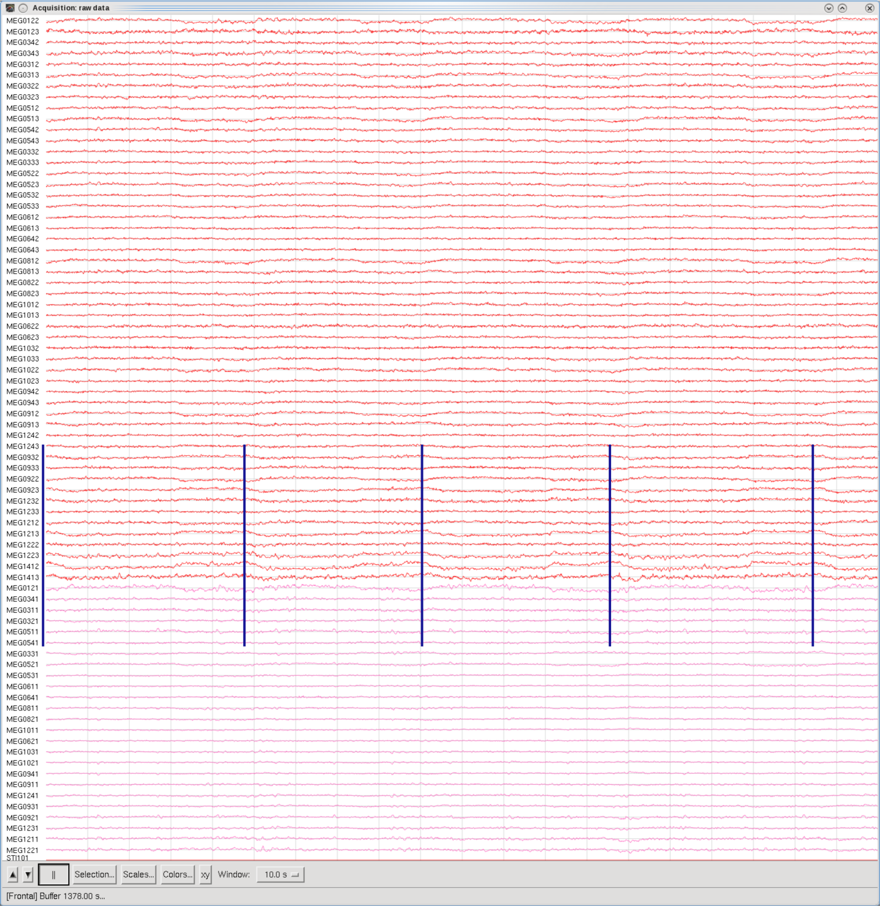 Eye blinks (every 2sec), Frontal set, 10sec Window