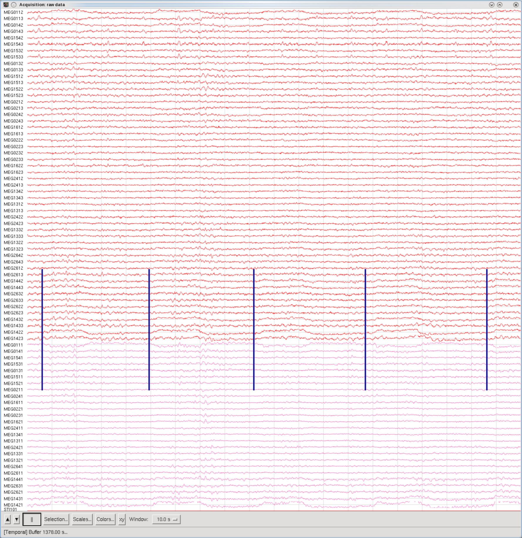Eye blinks (every 2sec), Temporal set, 10sec Window