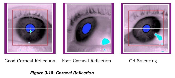 Poor Corneal Reflection