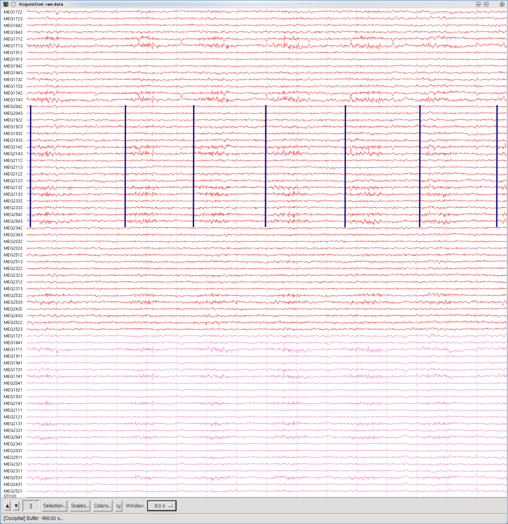 Shrug shoulders, Occipital set, 8sec Window