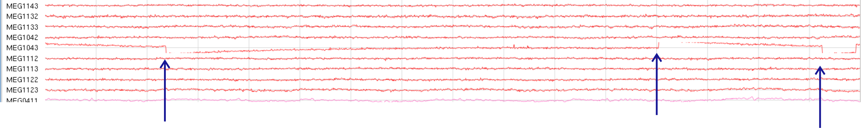 Parietal set, 8sec Window