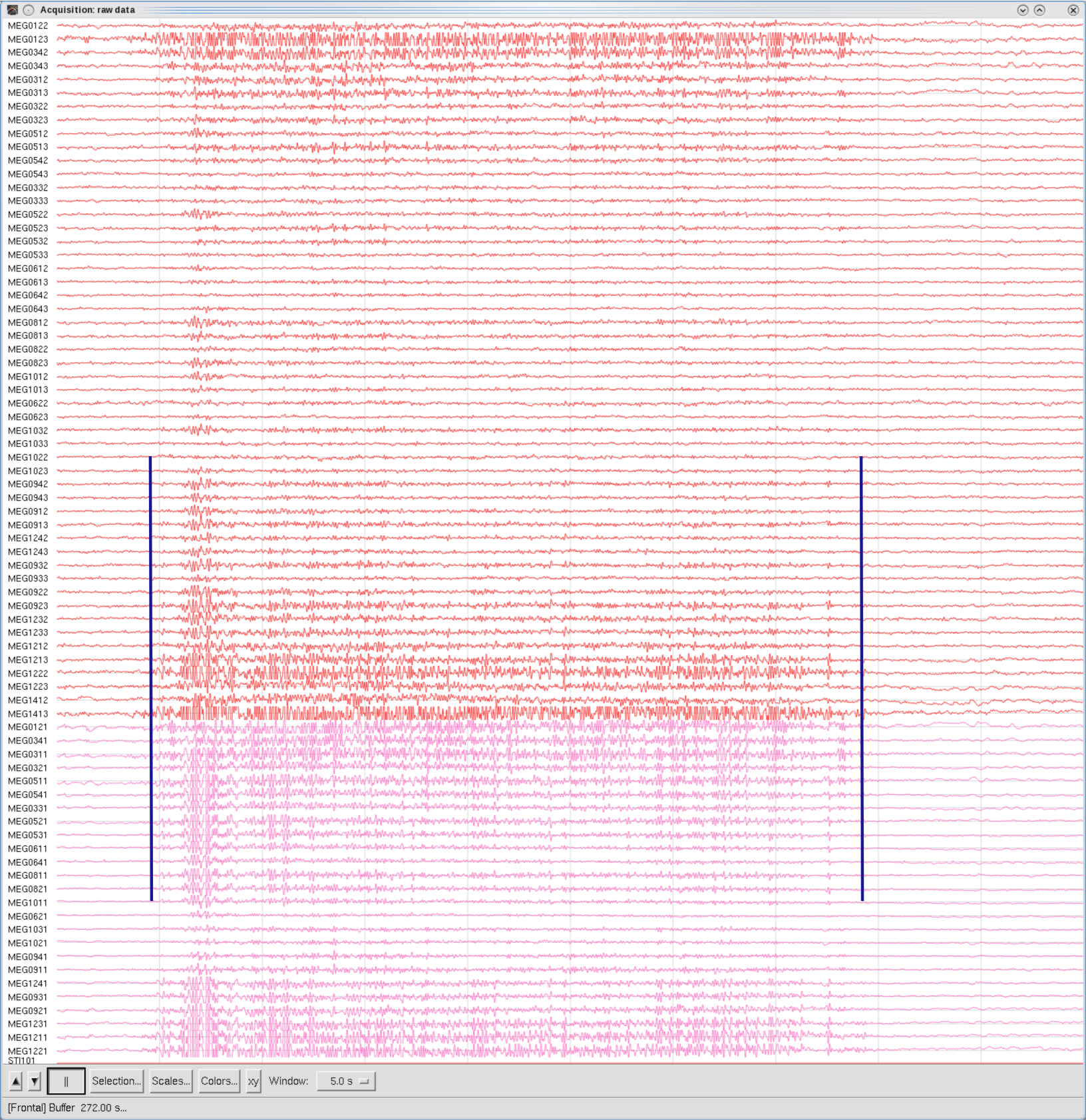 Clench Teeth, Frontal set, 5sec Window