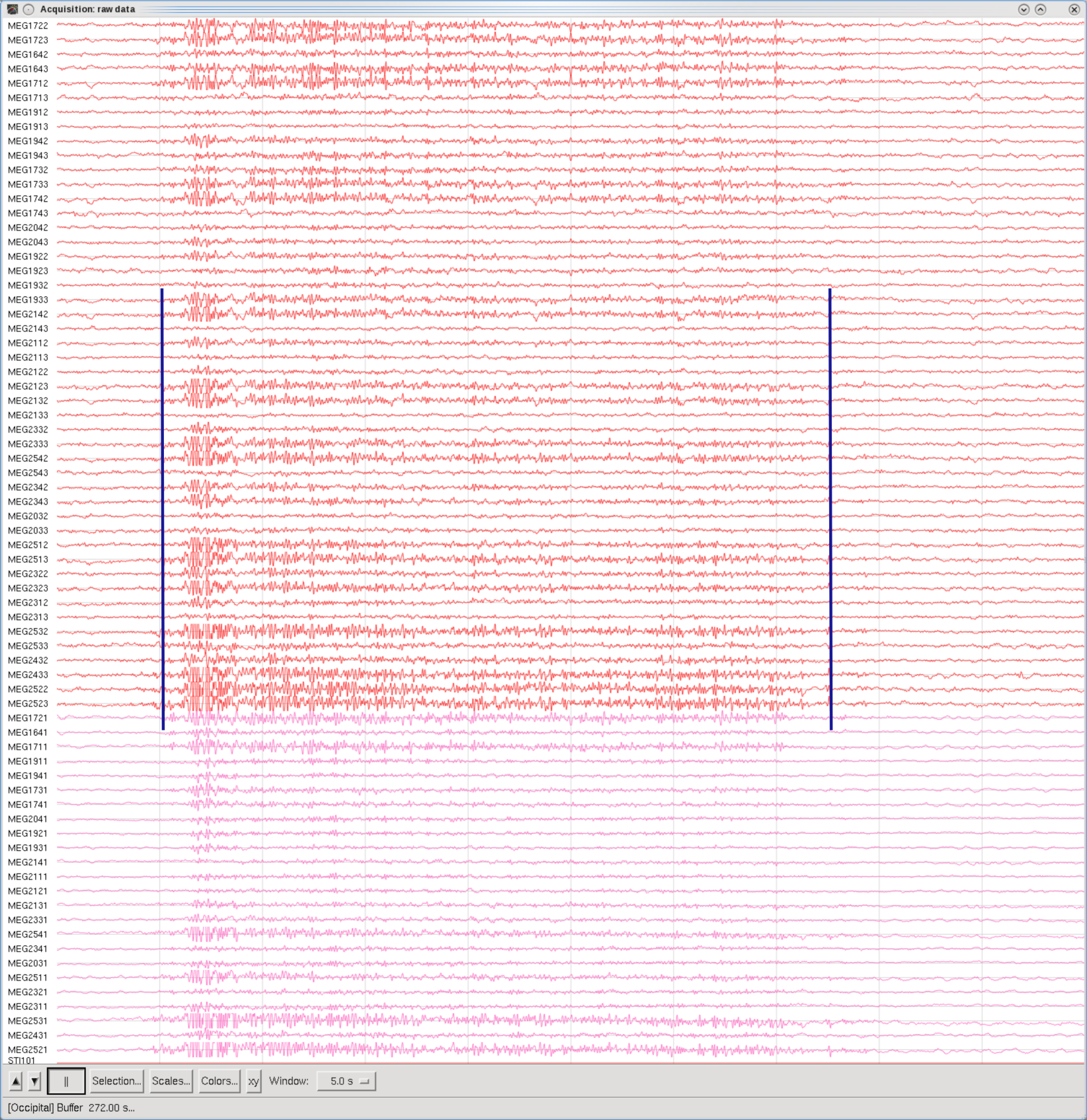 Clench Teeth, Occipital set, 5sec Window