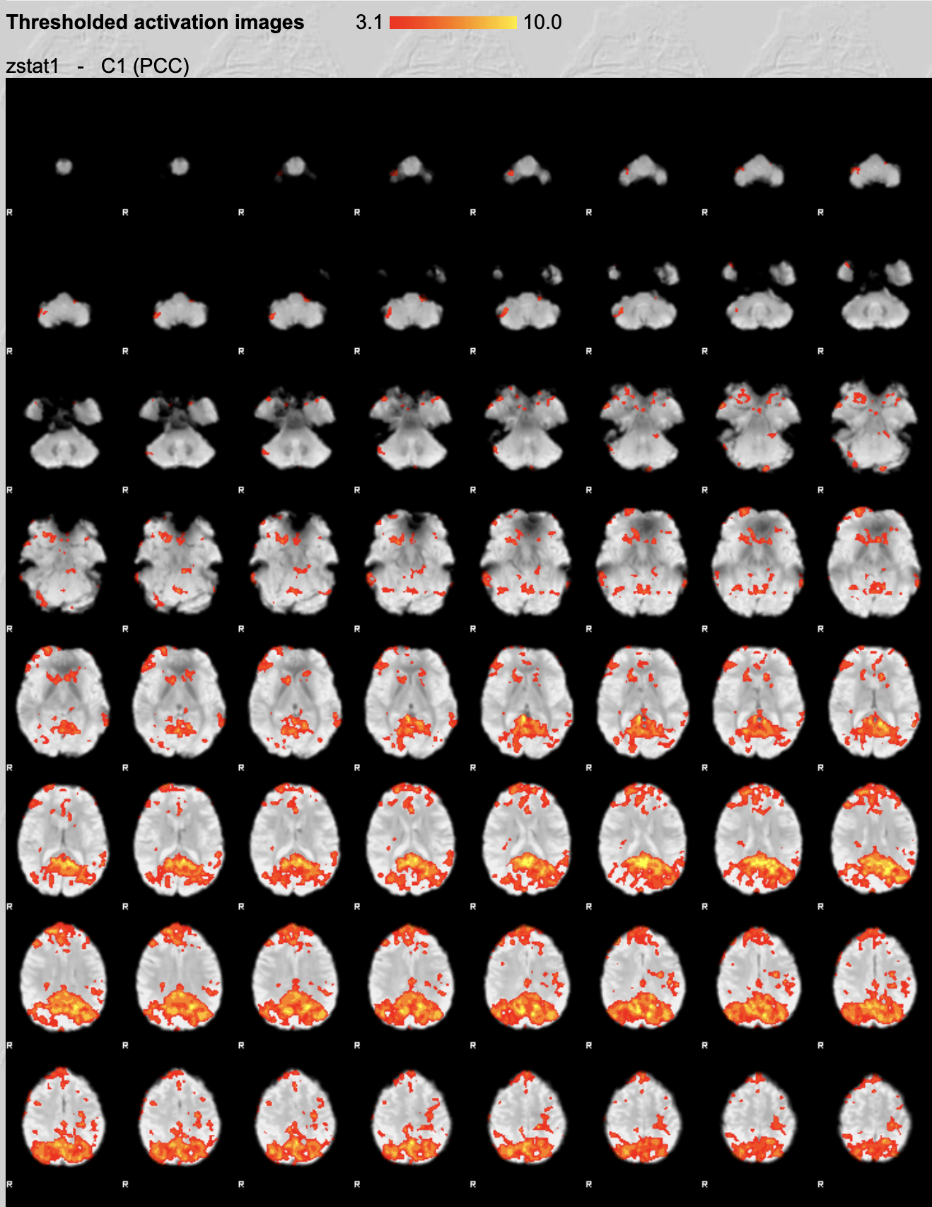 Sunject 1 Brain